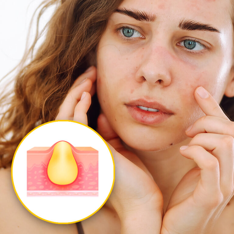 Acne mujer adulta